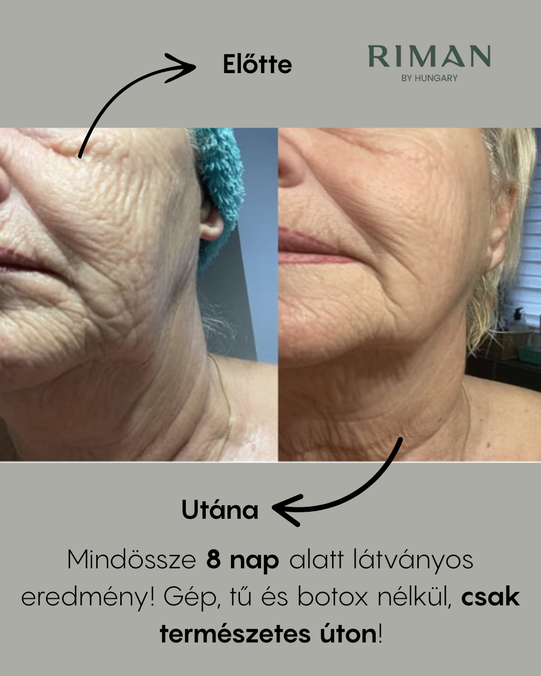 RIMAN előtte-utána — 8 nap alatt látványos eredmény